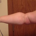 23 dpi. You can see the red at the bottom from the healing and swelling. You can see the tight band of skin at elbow.