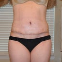 10 DPO front with incision
