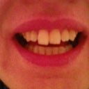 After 36 aligners