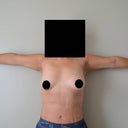 4 weeks after arm lipo... i'm not sure yet if it was worth it or not.  Verdict is still out.