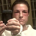 pic taken 15 hours after Active FX on eyes