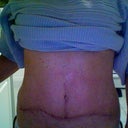 post up 10 weeks.  I think the Scar Fx sheets are working on the vertical scar