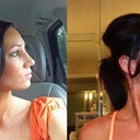 The left side was taken a month after surgery. You can see a little swelling bump on the bridge. Right was taken 1 week ago...the bump is pretty much gone...