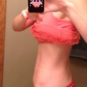 24 Days Postop - a little more swollen on this side than the other.  Was worried it was fat - PS laughed and said no, it is swelling :)
