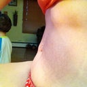 24 Days Postop sitting