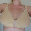 3 days post op, Sooooo BIGGGGG