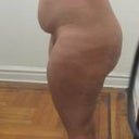 pre-op side