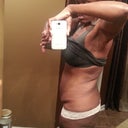 Before (left side) tummy flap and no butt due to 148lb weight loss over the years!