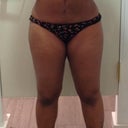 Front view, same outfit for reference, 3 days post, im still swollen & a lil bruised