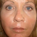 8 days post