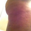 Seven days post op