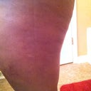 Seven days post op