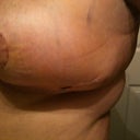 1 wk post op - still extremely swollen and hard in feel
