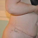 Two weeks post op, bruising at site of drains but I am pretty pleased!