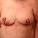 Day 2 post op