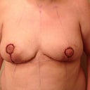 day 2 post op