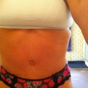 I need some scar relief for my belly button