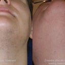 This is a before and after treatment of laser hair removal done my Dr lee. While I still need maybe 1 or 2 more treatments the results thus far are amazing. The after picture is about 2-3 months after my 4th treatment.