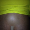 Seroma! EW!!