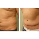 Abdominoplasty