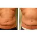 Abdominoplasty