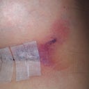 Day 2: Lt breast bruising (gotten worse from the Hanes sports bra band caving in... ouch!!!).. what is that white thing inside the steri strip???