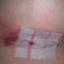 Day 2: Rt breast bruising in (also feels like gotten worse from the Hanes sports bra band)