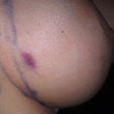 Day 2: Bruise in the mid lat of the Lt breast - still same from yesterday