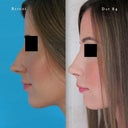 Profile Progression - Before vs. Day 84