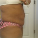My left side before procedure. It's way bigger than my rght. Strange