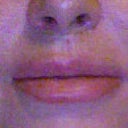 This is with bare minerals makeup over the scars. Well I'm slightly smiling here, so I'm not sure how the corner lift is going to turn out! See the vast difference betw. day after surgery and next day? :(