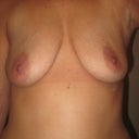 Day 1 - Post Explant. Tape on armpit incision