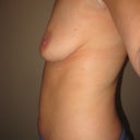 Day 1 - Post explant. Very flat on top. Tape on armpit incision.