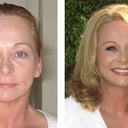 before and after: I love my natural-looking results, I couldn't be happier!