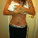 8 days post op.  First time I took of my binder and actually took a look.  So amazed!  Love it and its only the 8th day!