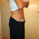 8 days post op side view