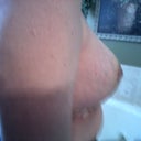 right side tape off post op day 10..a little blurry