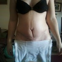 front view-23 days post op