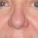 No change after rhinoplasty