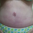 6 weeks post op