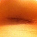 Left scar 1 week postop