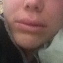 Had fat injected into my lips.  This was day of surgery. They were so puffed up and swollen!