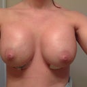 9 days post op (with 450cc moderate plus profile smooth round silicone unders)
