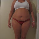 Pre Procedure Front View