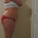 Pre Procedure Side View