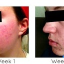 Left side view of Month 1.