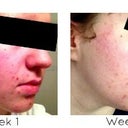 Right side view of Month one.