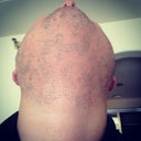 My husbands beard, after one treatment of laser hair removal