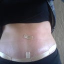 A little swollen in this picture. Using ScarAway silicon strips. I cut them in half to get 3 weeks worth out of one box. Picked them up at meijer.
