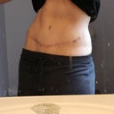 Ignore the messy mirror.  This is about 30wks (7 1/2 months) post surgery.  I have sutures from the dog ear revision.  Pretty pleased overall.